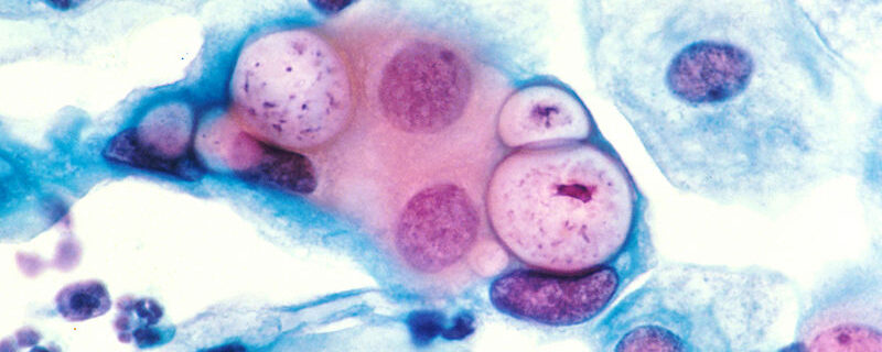 800px-Pap_smear_showing_clamydia_in_the_vacuoles_500x_H&E